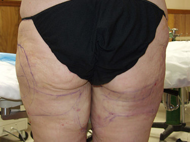 Laser Liposuction Dayton OH Patient 31 After