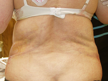 Laser Liposuction Dayton OH Patient 33 After