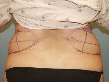 Laser Liposuction Dayton OH Patient 33 Before