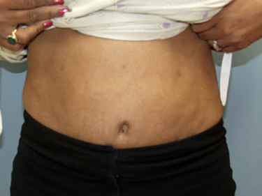 Liposuction Dayton OH Patient 44 After