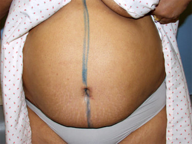 Liposuction Dayton OH Patient 44 Before