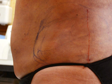 Liposuction Dayton OH Patient 45 After