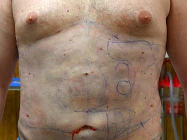 Liposuction Dayton OH Patient 46 After