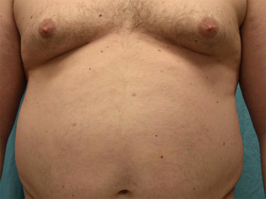 Liposuction Dayton OH Patient 46 Before