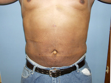 Liposuction Dayton OH Patient 47 After