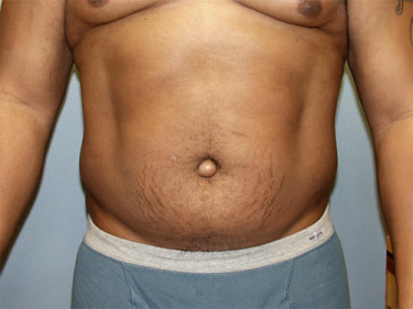 Liposuction Dayton OH Patient 47 Before