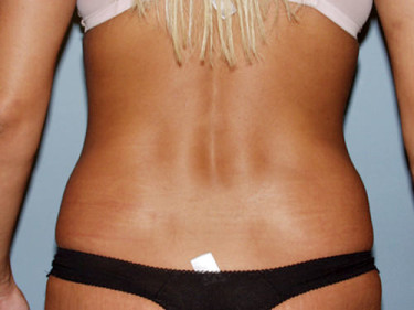 Liposuction Dayton OH Patient 49 After