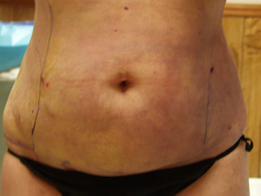 Liposuction Dayton OH Patient 50 After