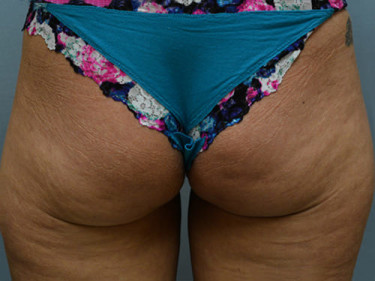 Liposuction Dayton OH Patient 56 Before