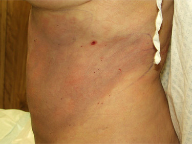 Liposuction Dayton OH Patient 57 After