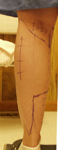 Liposuction Dayton OH Patient 59 Before