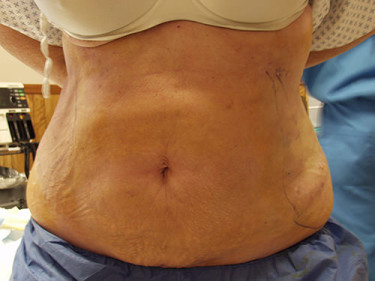 Liposuction Dayton OH Patient 60 After