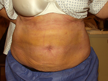 Liposuction Dayton OH Patient 60 Before