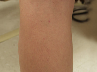 Vein Therapy Dayton OH Patient 84 After