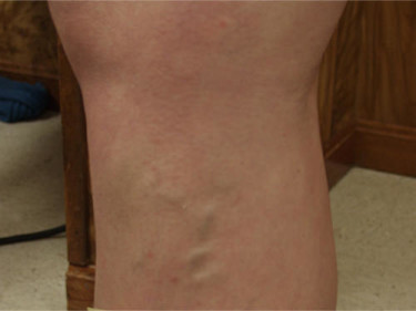 Vein Therapy Dayton OH Patient 84 Before