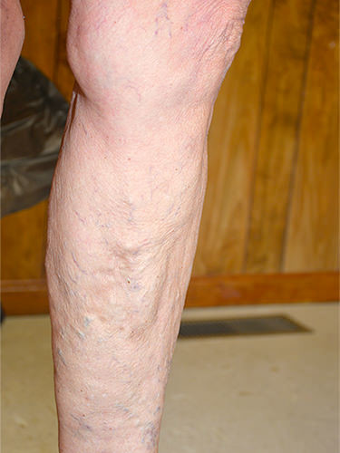 Vein Therapy Dayton OH Patient 86 After