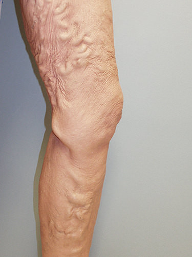 Vein Therapy Dayton OH Patient 86 Before