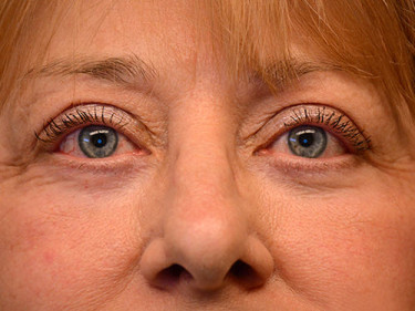 Blepharoplasty Dayton OH Patient 16 After