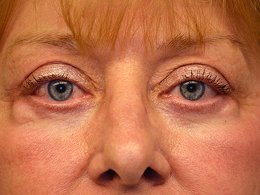 Blepharoplasty Dayton OH Patient 16 Before