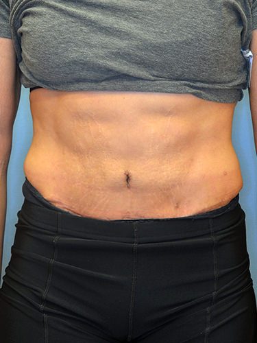 Tummy Tuck Dayton OH Patient 129 After