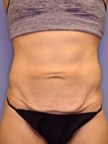 Tummy Tuck Dayton OH Patient 129 Before