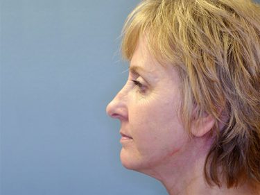 Facelift Dayton OH Patient 131 After