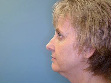 Facelift Dayton OH Patient 131 Before