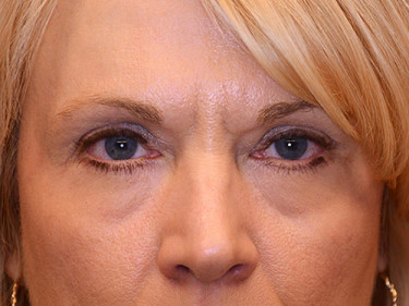 Blepharoplasty Dayton OH Patient 17 After