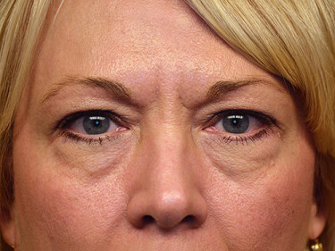 Blepharoplasty Dayton OH Patient 17 Before